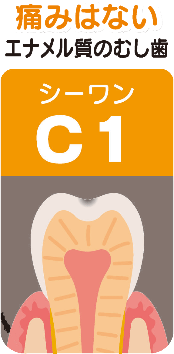 C1（シーワン）痛みはない～エナメル質のむし歯～
