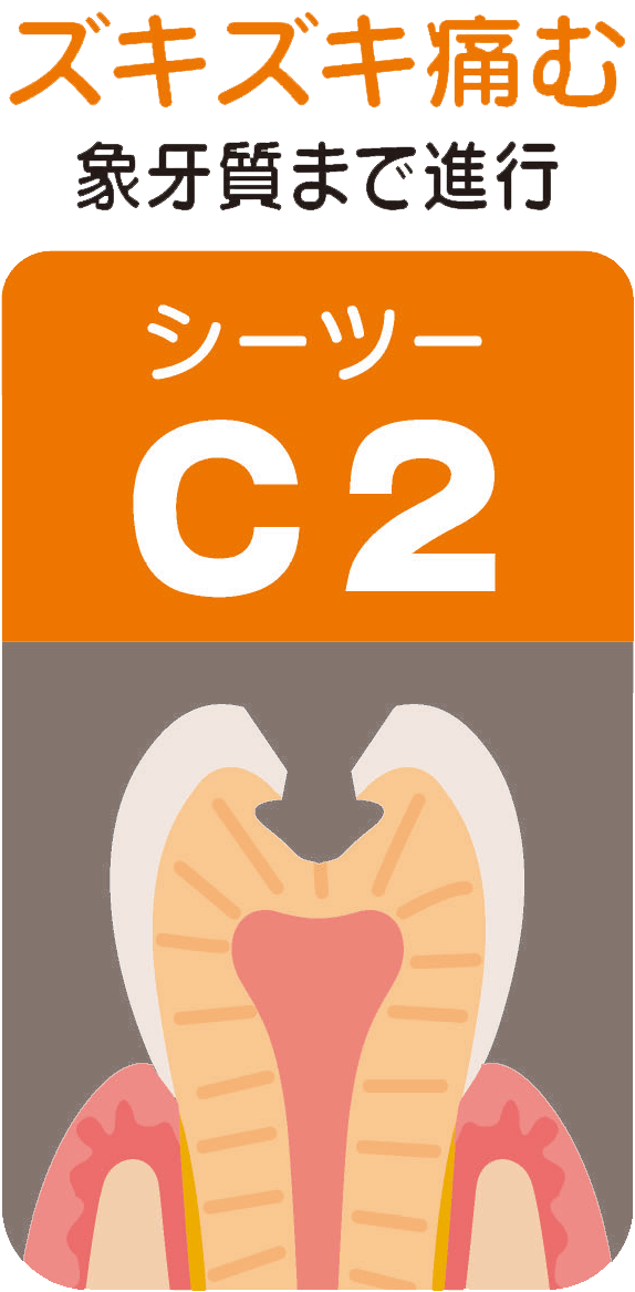 C2（シーツー）ズキズキ痛む～象牙質まで進行～