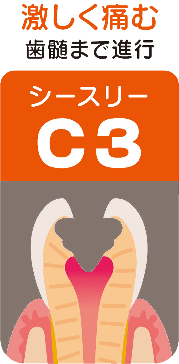 C3（シースリー）激しく痛む～歯髄まで進行～