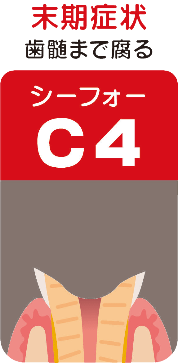 C4（シーフォー）末期症状～歯髄まで腐る～
