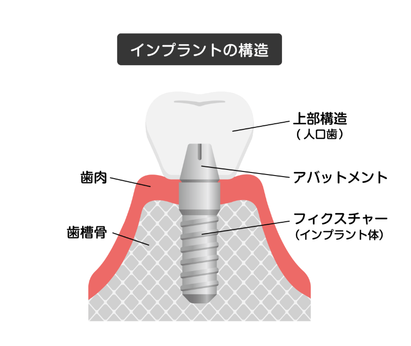インプラントの構造を解説したイラスト