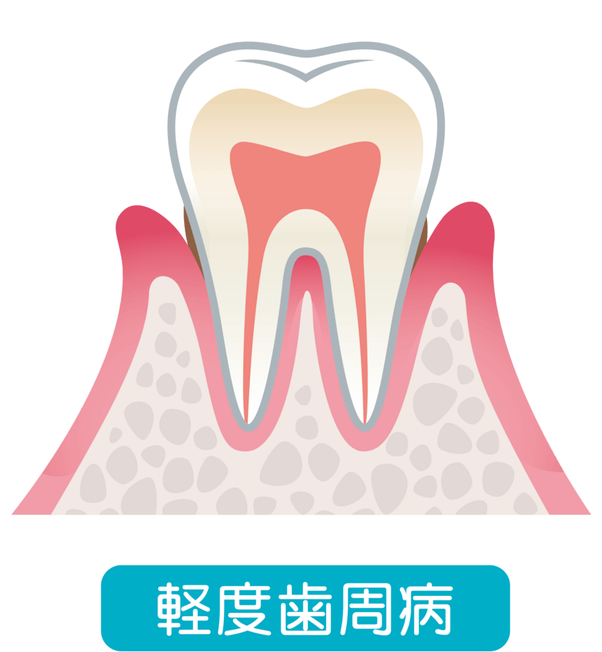 軽度歯周病のイラスト