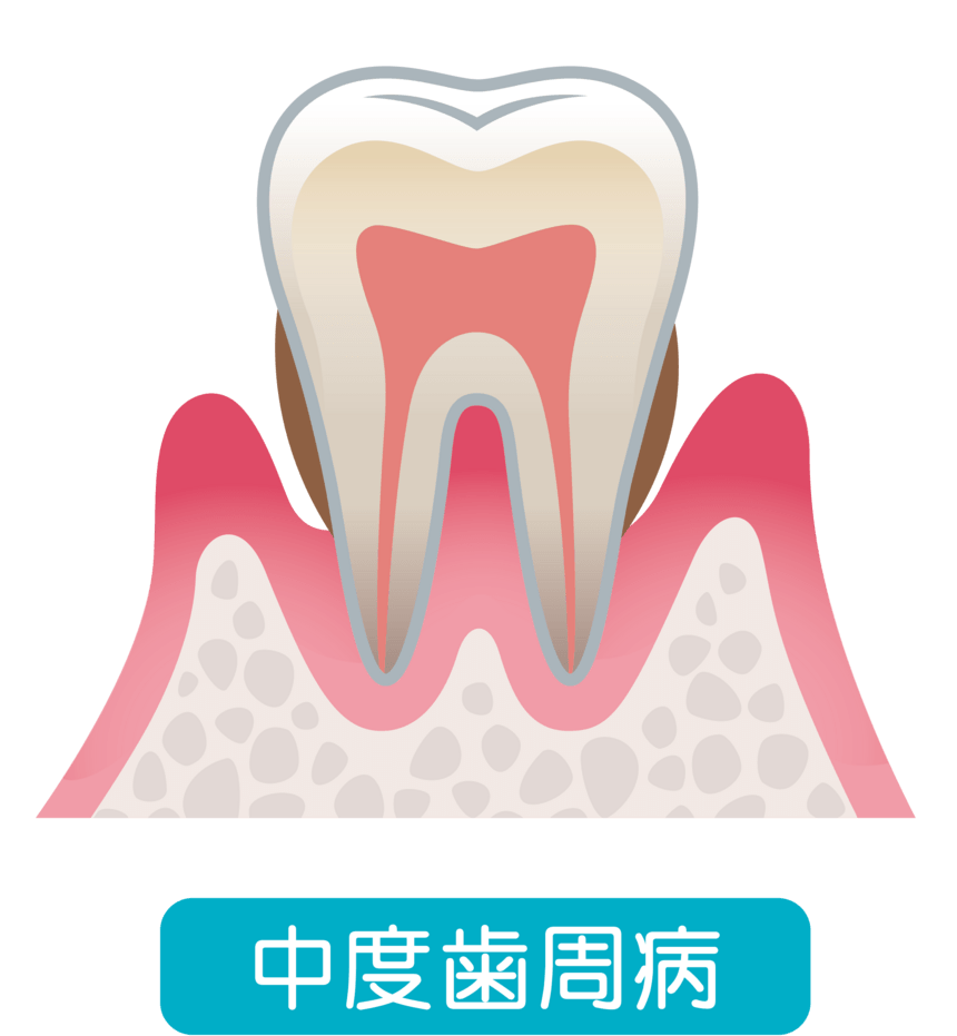 中度歯周病のイラスト