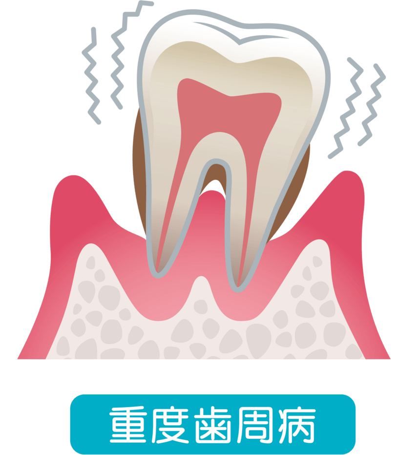 重度歯周病のイラスト
